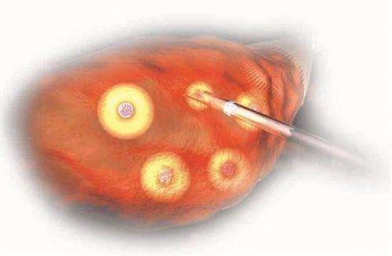 格鲁吉亚Innova医院专家解释促排卵有几种方式？